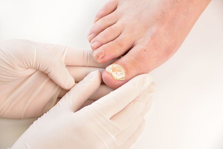 Before prescribing treatment, the doctor must diagnose the nail fungus