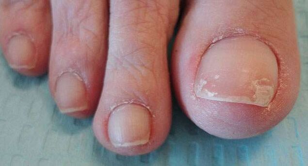 One of the symptoms of onychomycosis is the detachment of the nail plate. 