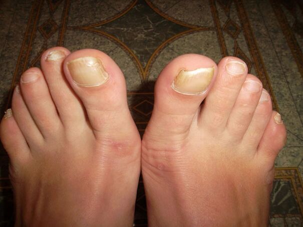 Thickening of the nails with onychomycosis