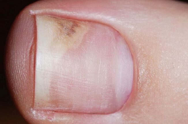 Signs of onychomycosis at the initial stage - lack of shine, gap between the nail and the bed