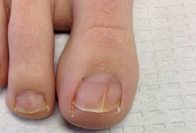 Visual manifestations of toenail fungus at the initial stage