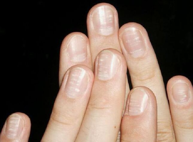 White spots on nails are a sign of fungus development