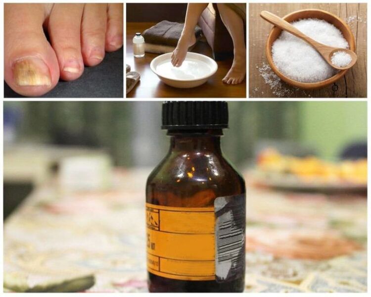 recipes with iodine to relieve fungal infections