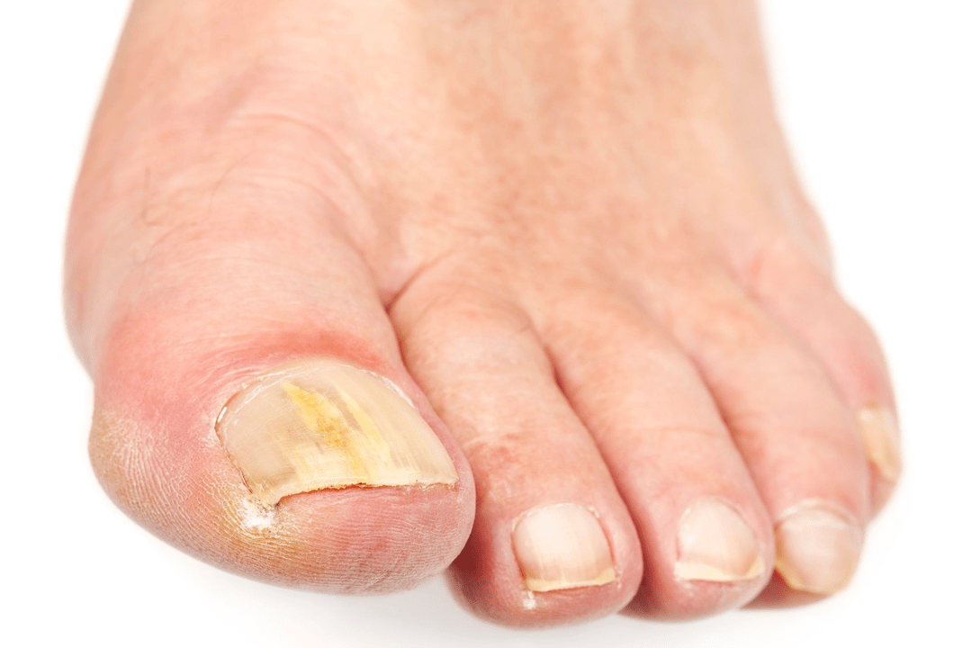 fungal infection of nail plates