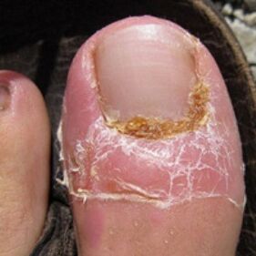 Nail mushroom