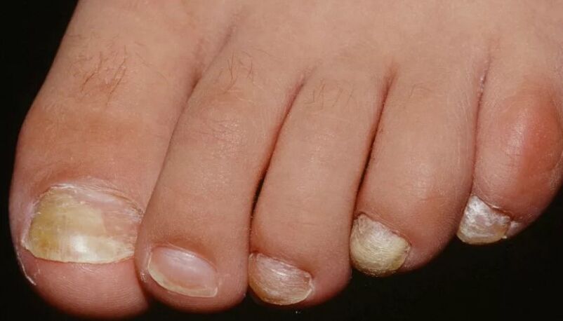 The fungus of the nail on the go