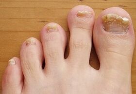 In onychomycosis