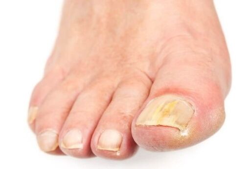 Fungus on the nails
