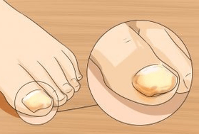 Nail mushroom