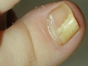 Nail mushroom