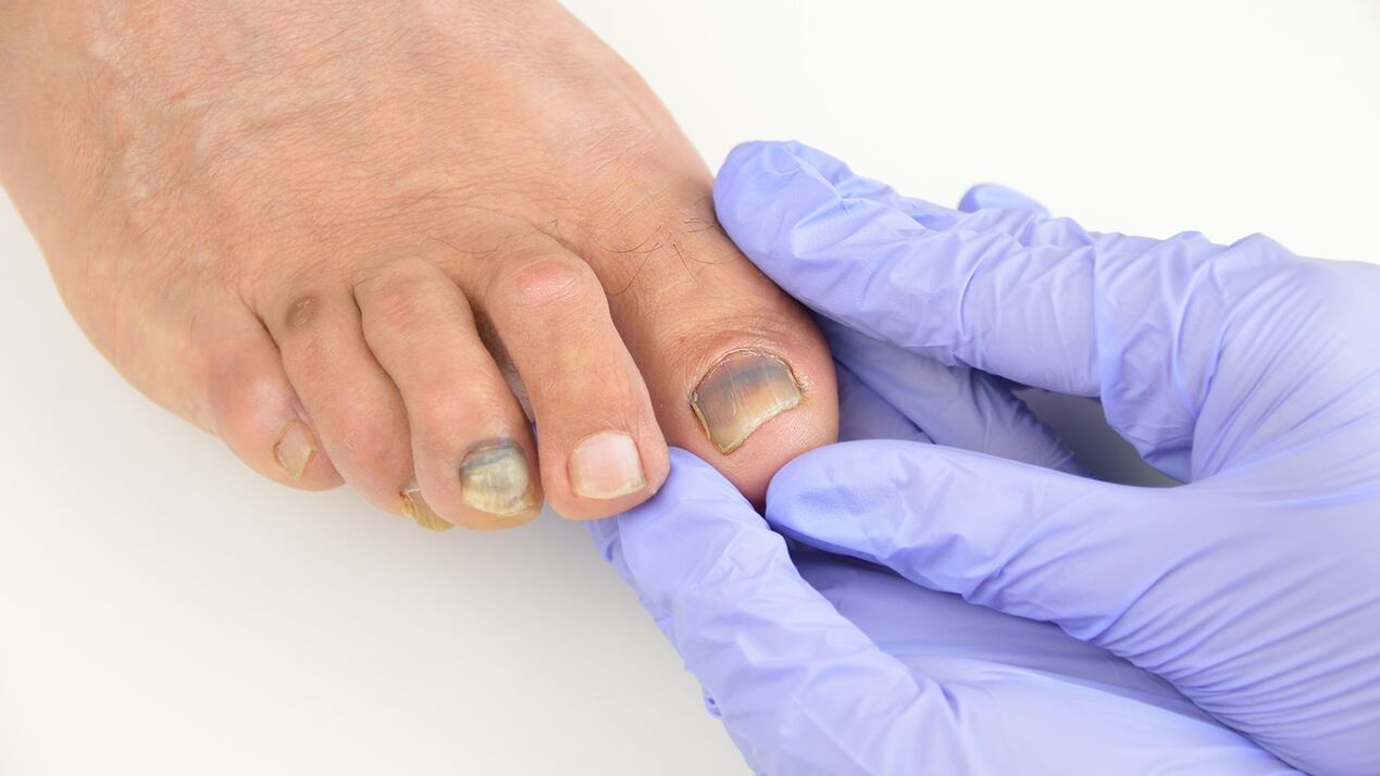 Inspection of the foot fungus