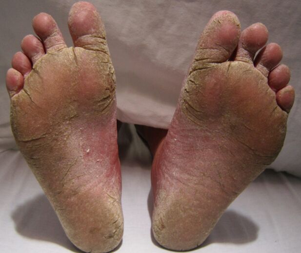 Mycotic feet defeat