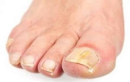The initial mushroom stage on the foot nail