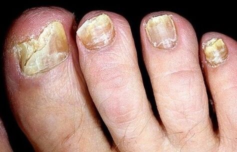 The nails collapse from the fungus