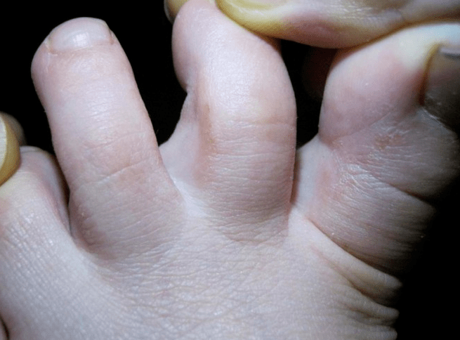 Mycosis in children