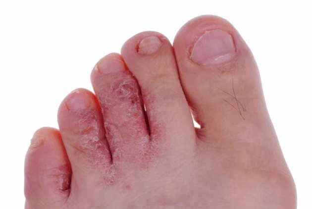 The advanced mycosis stadium