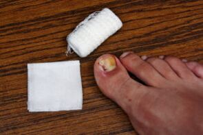 Compress with apple cider vinegar for mushroom treatment