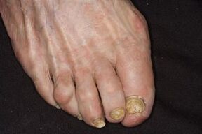 Treatment of nail mushrooms on the legs of apple cider vinegar