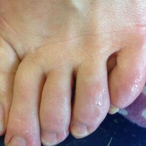 ways of infection with fungus