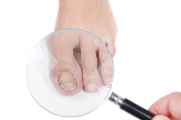 stages and stages of development of fungus on toenails