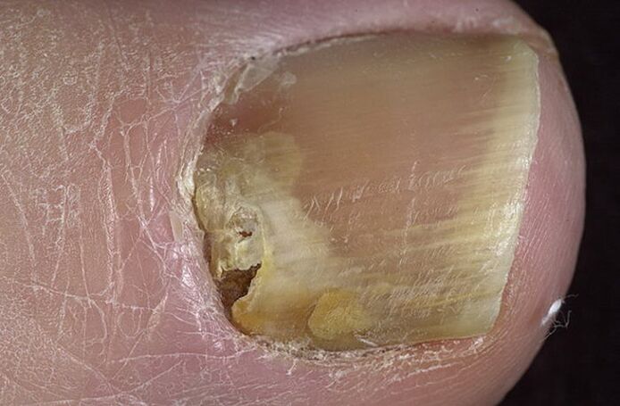fungus on nails