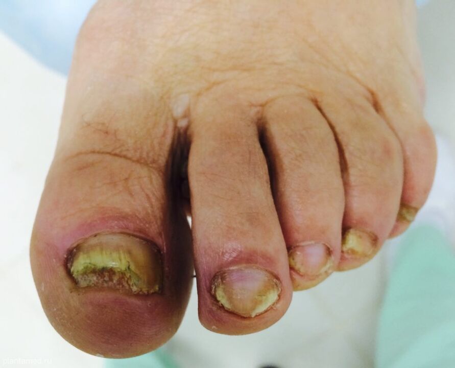 Severe nail deformation is a sign of the advanced third stage of the fungus