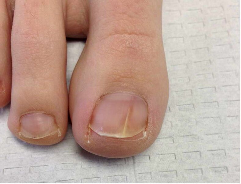 Stripes and spots on the big toenail during the first stage of fungal development